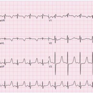 Patient Monitoring